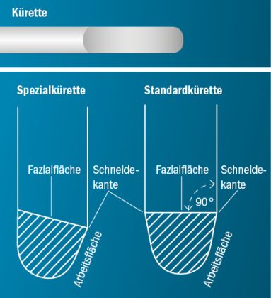 Welche Seite einer Kürette mit geschärft werden? Geometrischer Vergleich einer Garcey-Kürette und Universalkürette.